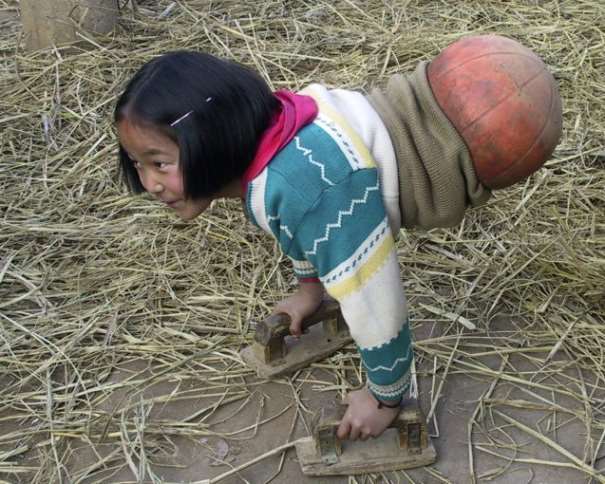 En esta foto podemos ver cómo Qian Hongyan, "la chica baloncesto" de China, se ayuda de sus manos para poder caminar, completando su cuerpo con un balón de baloncesto