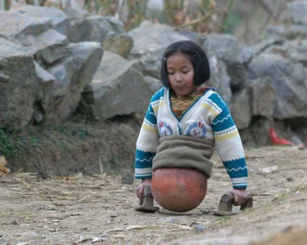 En esta foto podemos ver cómo Qian Hongyan, "la chica baloncesto" de China, se ayuda de sus manos, y de un balón de baloncesto, para poder caminar